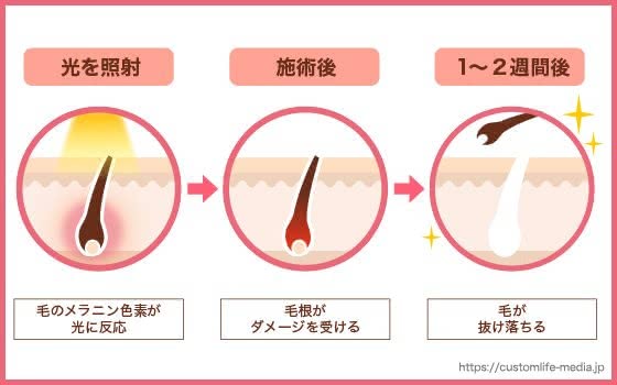 IPL脱毛の仕組み