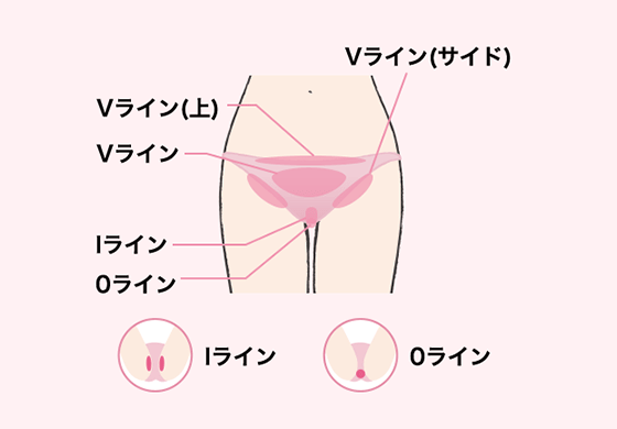 キレイモ脱毛部位:VIO脱毛