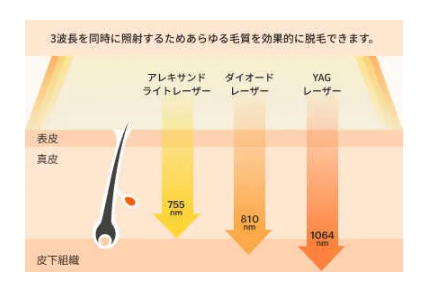 アリシアクリニック_レーザー波長_ソプラノチタニウム