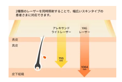 アリシアクリニック_レーザー波長_スプレンダーX